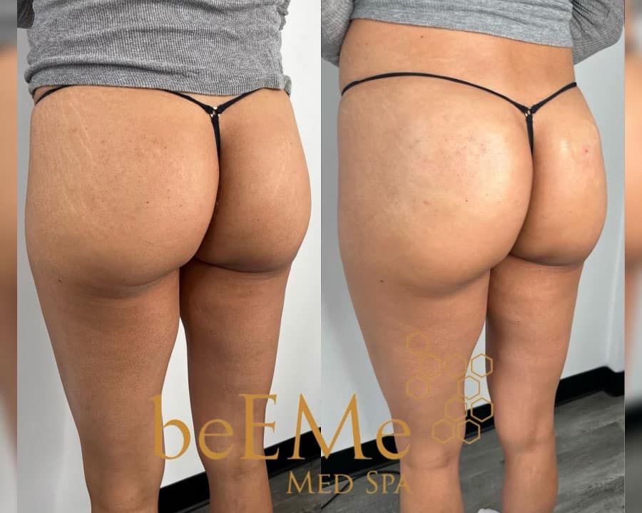 beeme-med-spa_houston-medical-spa_brazilian-butt-lift-02