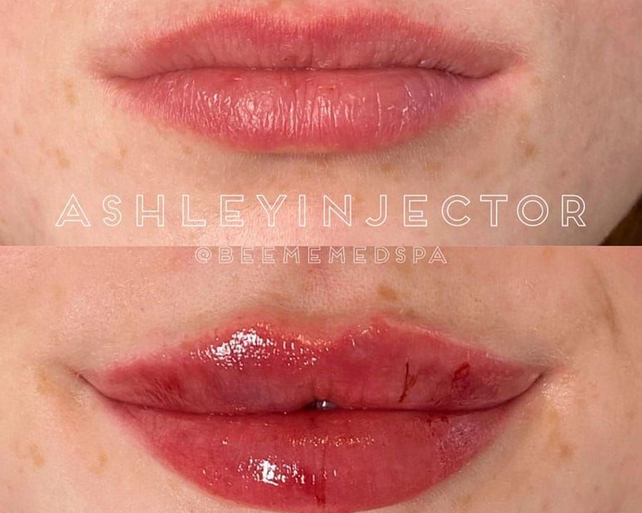 beeme-med-spa_houston-medical-spa_Russian-Lip-Filler-2