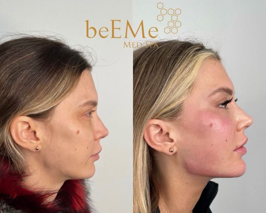 beeme-med-spa_houston-medical-spa_morpheus-8-01