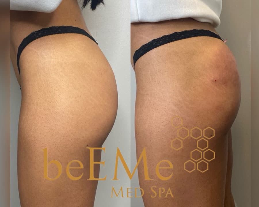 beeme-med-spa_houston-medical-spa_brazilian-butt-lift-03