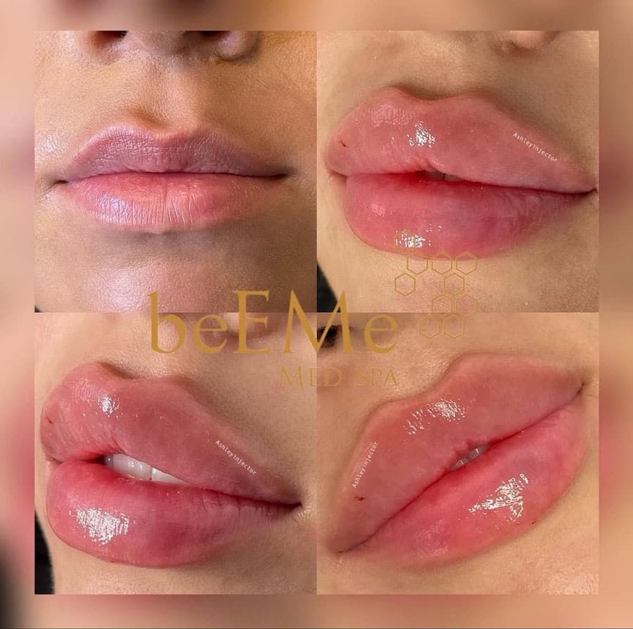 beeme-med-spa_houston-medical-spa_lip-filler-01