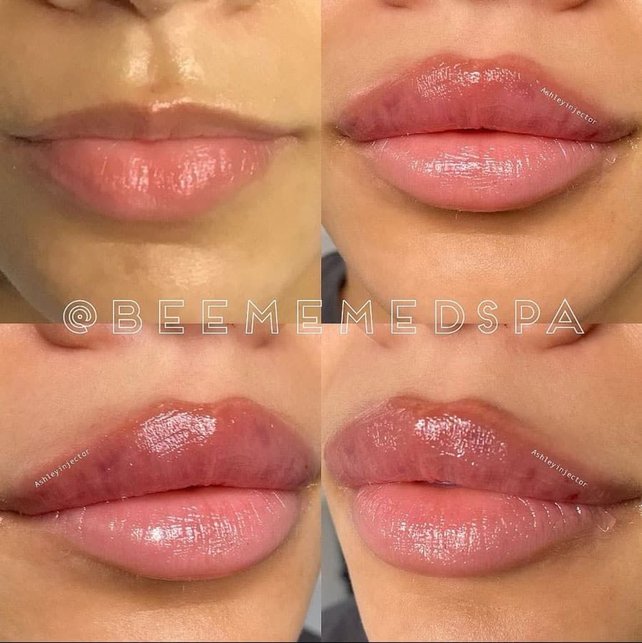 beeme-med-spa_houston-medical-spa_lip-filler-02