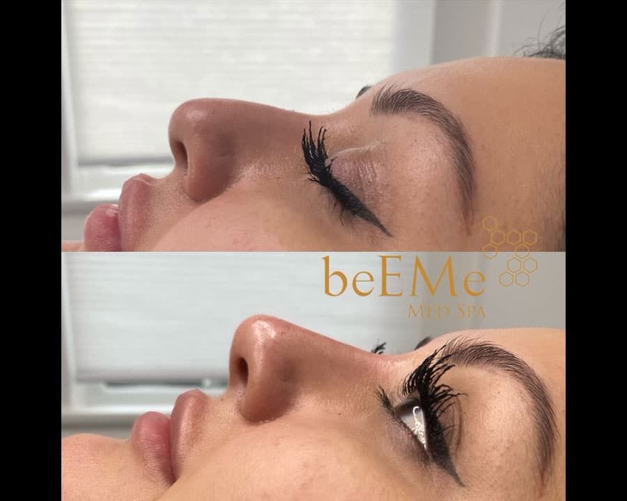beeme-med-spa_houston-medical-spa_non-surgical-rhinoplasty-03
