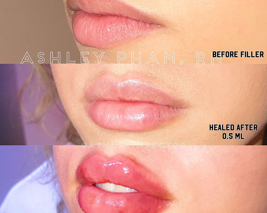 beeme-med-spa_houston-medical-spa_Russian-Lip-Filler-1