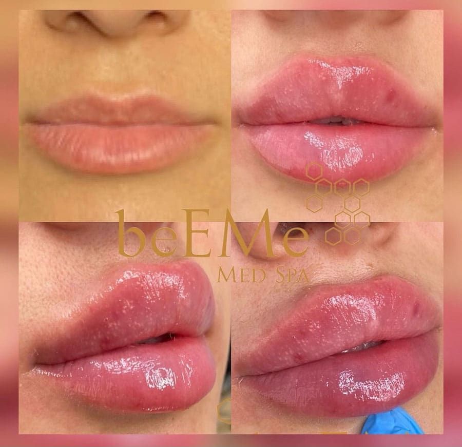 beeme-med-spa_houston-medical-spa_lip-filler-03