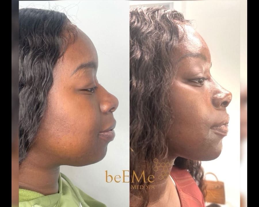 beeme-med-spa_houston-medical-spa_non-surgical-rhinoplasty-02