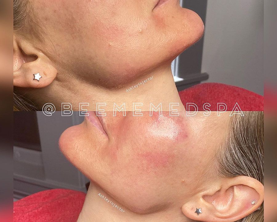 beeme-med-spa_houston-medical-spa_jawline-filler-03