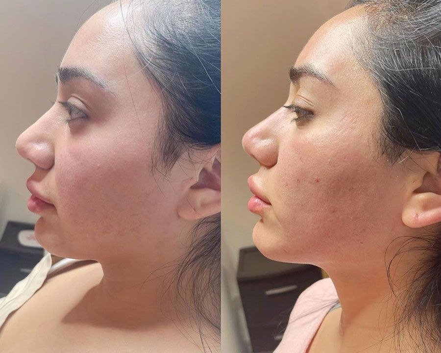 beeme-med-spa_houston-medical-spa_morpheus-8-03