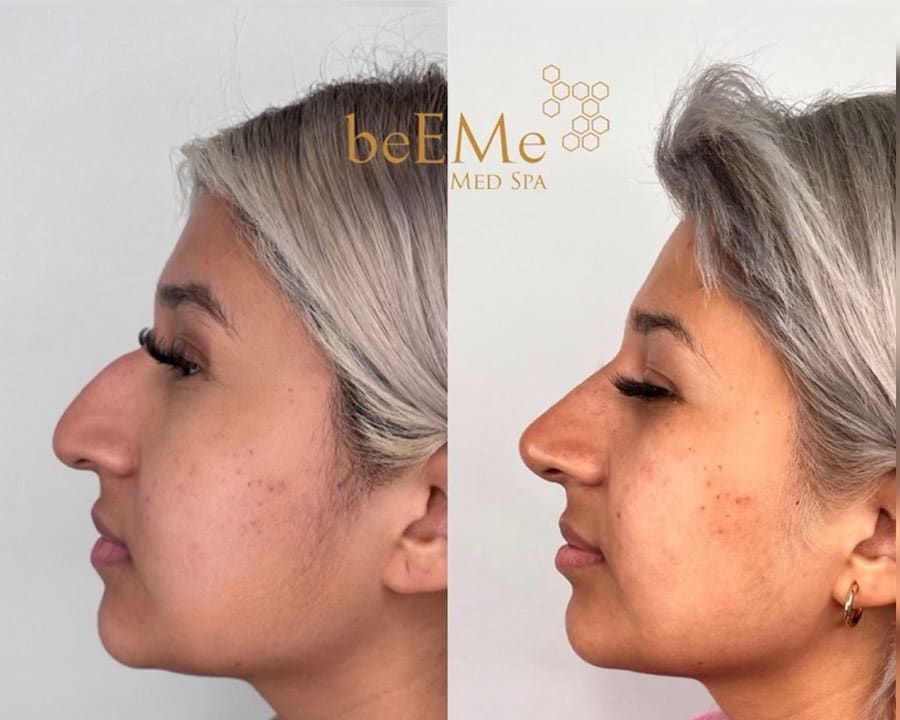 beeme-med-spa_houston-medical-spa_non-surgical-rhinoplasty-01
