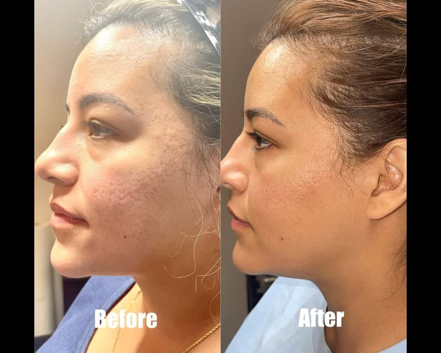 beeme-med-spa_houston-medical-spa_morpheus-8-02