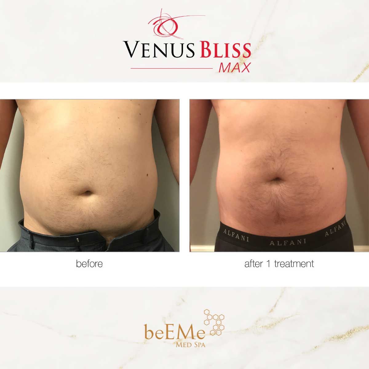 beeme-med-spa_houston-medical-spa_venus-bliss-max-02