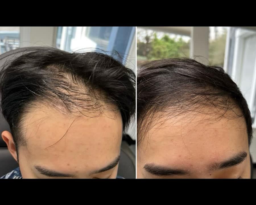 beeme-med-spa_houston-medical-spa_hair-restoration-03