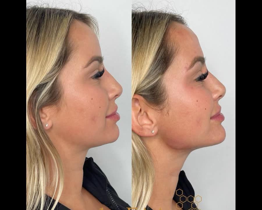 beeme-med-spa_houston-medical-spa_jawline-filler-02