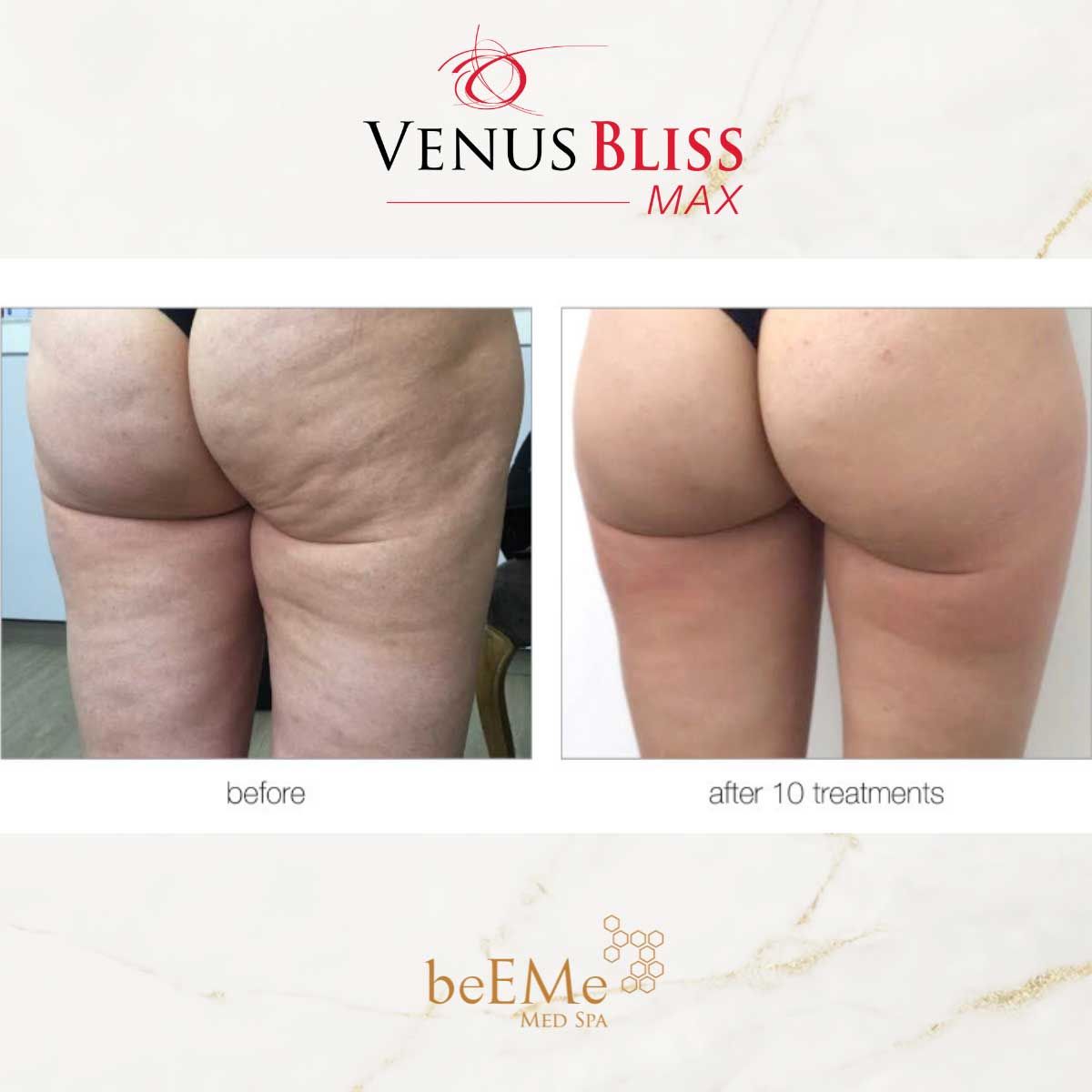 beeme-med-spa_houston-medical-spa_venus-bliss-max-01